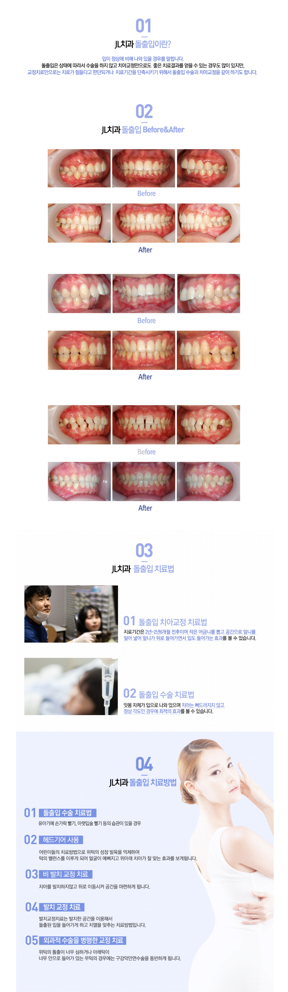 돌출입교정